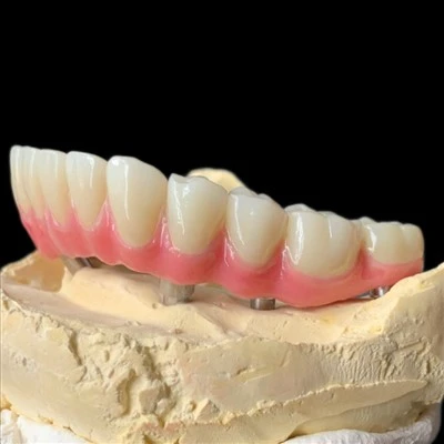 Full Arch Zirconia Implant Malong Bridge