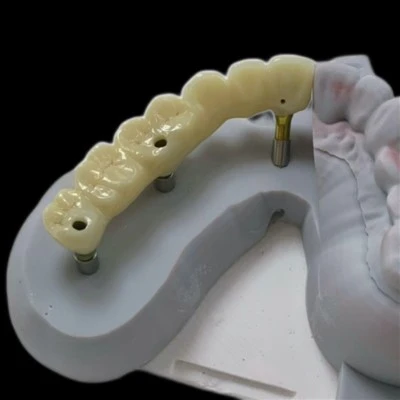 Zirconia-implantatbro med titandistanse